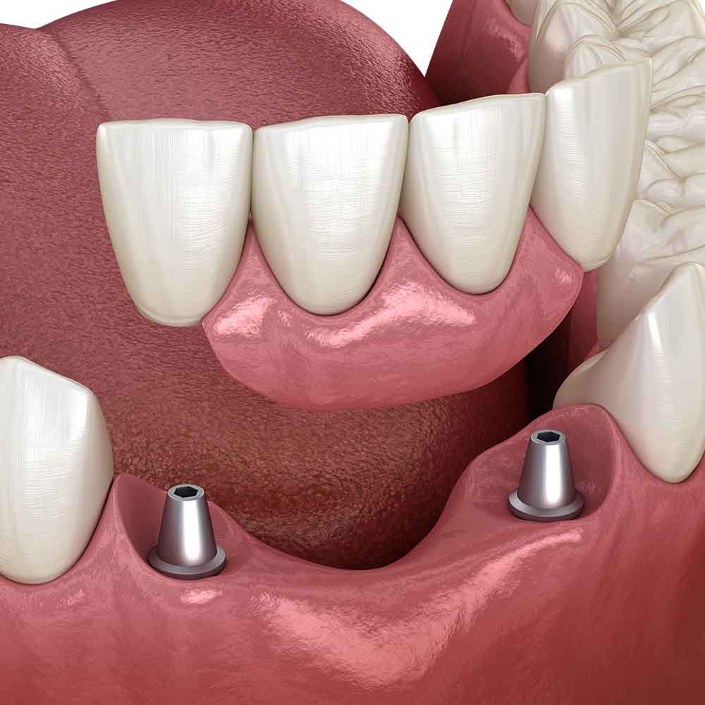 Permanent implant-supported dental bridge on the front teeth of the lower jaw