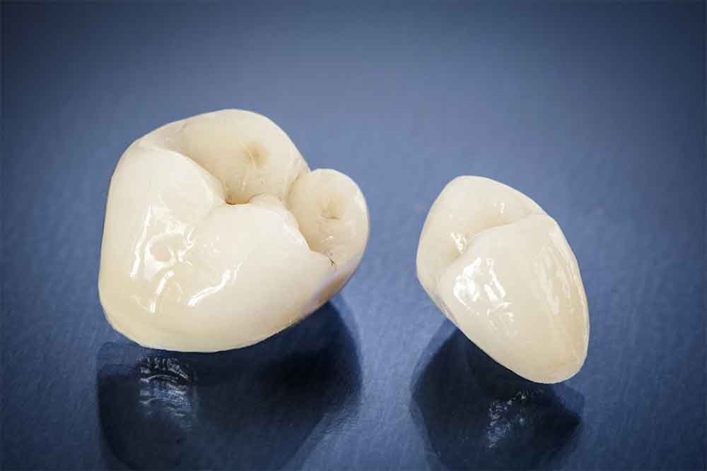 metal free ceramic dental crowns in ridgeland ms